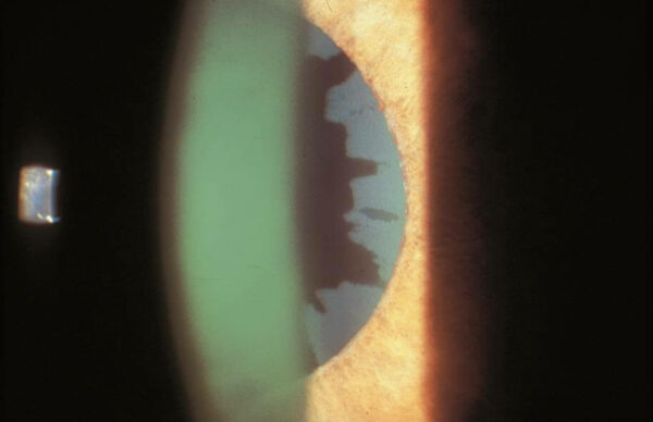What Are The Types Of Glaucoma Michigan Glaucoma Cataract
