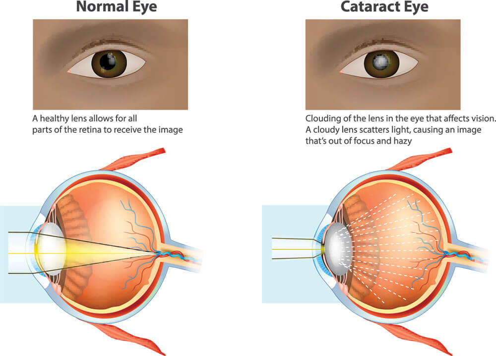 Chart Illustrating a Normal Eye Compared to One With a Cataract